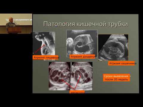 Видео: 19.02.2017 - Пренатальная диагностика пороков развития у детей
