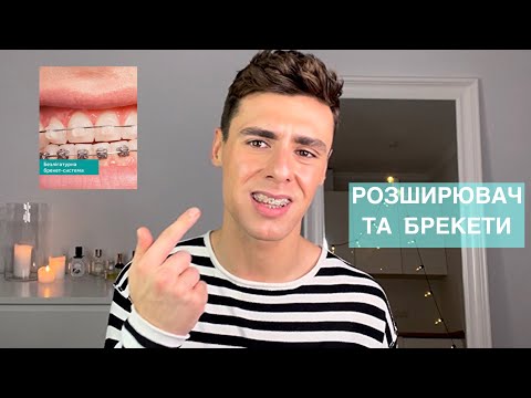 Видео: 5 місяців з БРЕКЕТАМИ | Розширення щелепи, ОЧІКУВАННЯ І РЕАЛЬНІСТЬ, особливості догляду за зубами