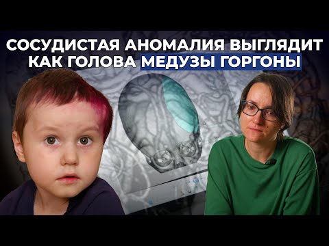 Видео: АРАХНОИДАЛЬНАЯ КИСТА, АРТЕРИОВЕНОЗНАЯ МАЛЬФОРМАЦИЯ | История Максима Саушкина