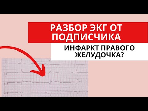 Видео: Разбор ЭКГ от подписчика. Инфаркт правого желудочка? (Острый коронарный синдром)