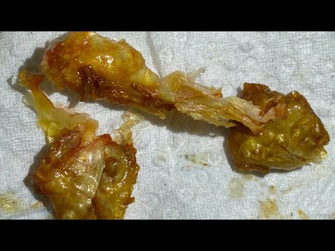 Видео: 1603 — сложное удаление обтурирующего кератоза 3 степени с использованием #WAXscope®️ и #iCLEARsc...