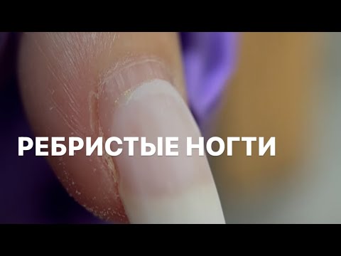 Видео: РЕБРИСТЫЕ НОГТИ (продольные борозды на ногтях)