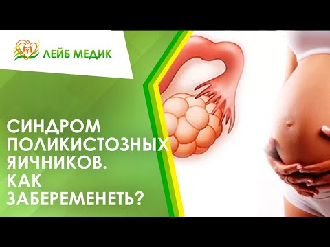 Видео: 👩‍🦰 Как забеременеть с синдромом поликистозных яичников?