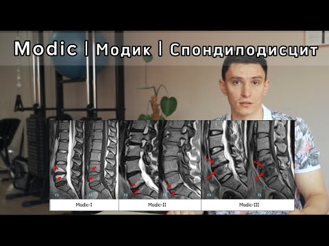 Видео: Modic | Модик | Спондилодисцит: симптомы, последствия и лечение