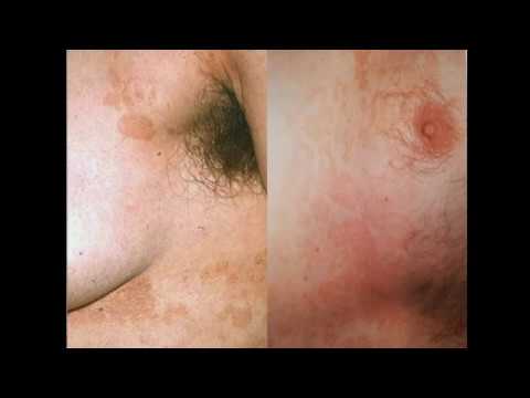 Видео: Отрубевидный (разноцветный) лишай.