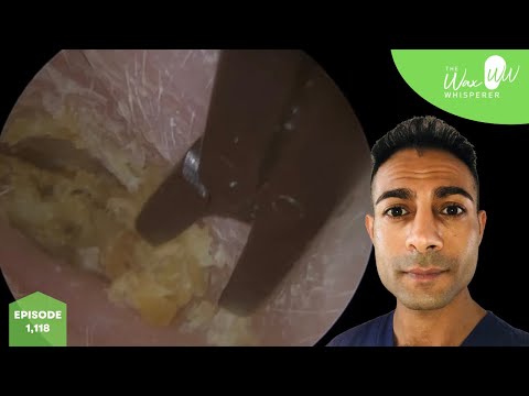 Видео: 1118 — Удаление щипцами сильно зудящей ушной серы и омертвевшей кожи