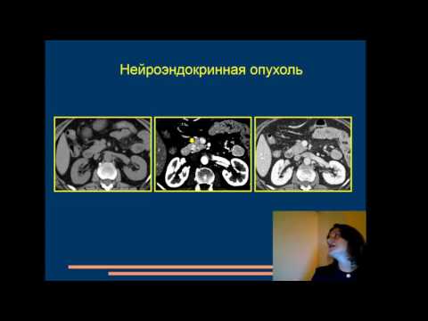 Видео: Лекция: "КТ-диагностика осложнений хронического панкреатита"