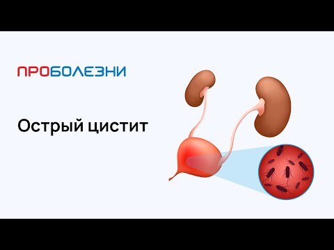 Видео: Острый цистит