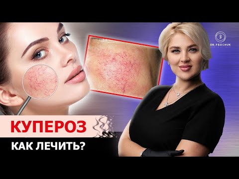 Видео: Как избавиться от сосудов на лице? Советы врача - косметолога