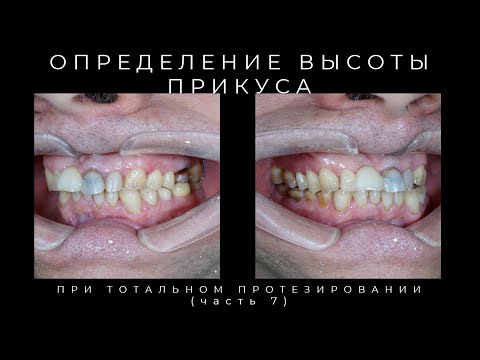 Видео: Определение Высоты Прикуса (часть 7)