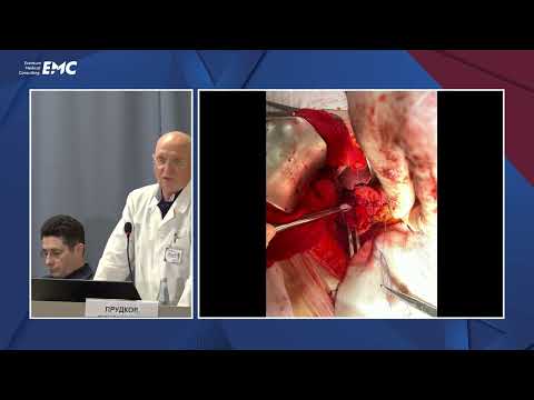 Видео: 22. Технические аспекты оперативного лечения трудных язв желудка и ДПК — Прудков Михаил Иосифович