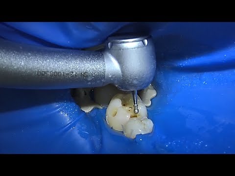 Видео: Препарирование мини версия