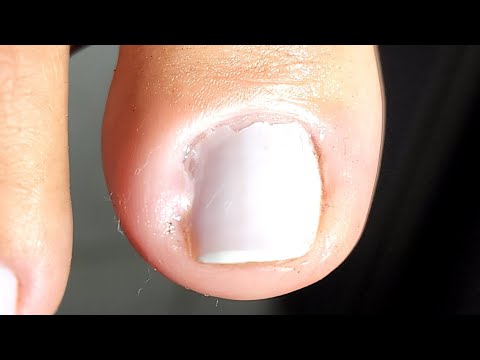 Видео: БЕРЕМЕННАЯ ЖЕНЩИНА С ЗАРАЖЕННЫМ НОГТЕМ. ТАК МНОГО БОЛИ! (с субтитрами)