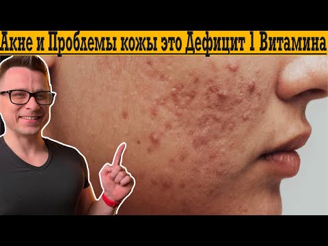 Видео: Акне и Проблемная КОЖА это Дефицит ￼всего 1 ВИТАМИНА!