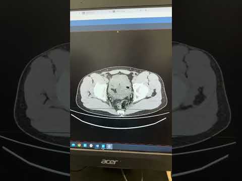 Видео: Хирург ставит диагноз острого аппендицита по КТ