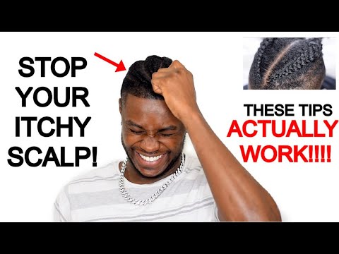 Видео: КАК ИЗБАВИТЬСЯ ОТ ЗУДА КОЖИ ГОЛОВЫ ОТ КОСИЧЕК/КОСОЧЕК | 𝙖𝙡𝙡 𝙩𝙝𝙚 𝙩𝙞𝙥𝙨 𝙮𝙤𝙪 𝙣𝙚𝙚𝙙 𝙩𝙤 𝙠𝙣𝙤𝙬