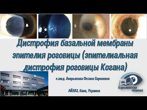 Видео: Дистрофия базальной мембраны эпителия роговицы (эпителиальная дистрофия роговицы Когана)