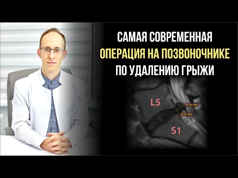 Видео: Эндоскопическое удаление грыжи межпозвонкового диска L5-S1: показания, этапы, риски, реабилитация