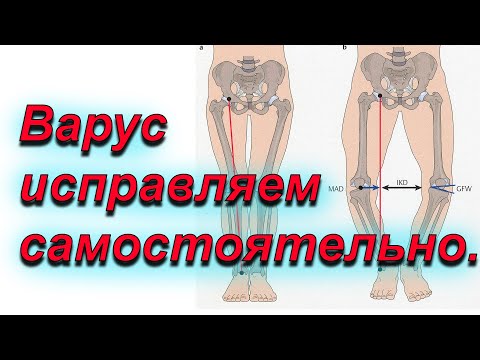 Видео: Исправляем кривые ноги.Варус.Упражнения.