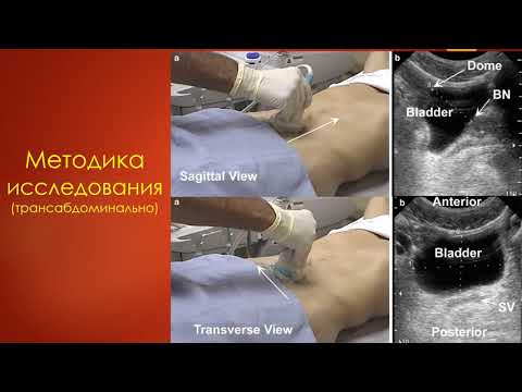 Видео: УЗИ мочевого пузыря. Станислав Феданов.