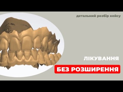 Видео: Лікування БЕЗ РОЗШИРЕННЯ | Ортодонтія | Розбір плану лікування | Б. Свінціцький