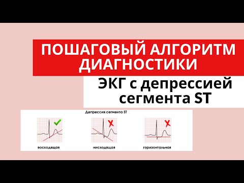 Видео: Причины депрессии сегмента ST? Как их отличать друг от друга? Дифференциальная диагностика.