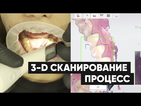 Видео: Внутриротовое 3D сканирование 3shape Trios 3 процесс | Sergatiy Dental Clinic
