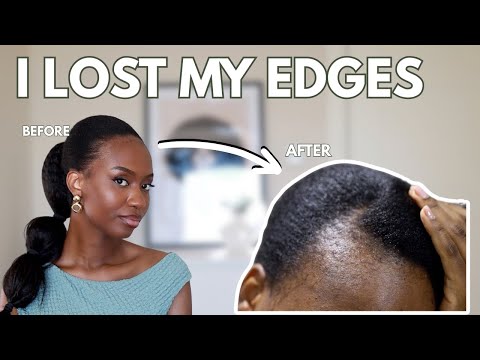 Видео: Послеродовое выпадение волос произошло