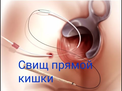 Видео: Свищ прямой кишки