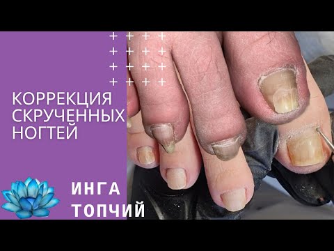 Видео: Вросший ноготь. Коррекция скрученных ногтей.