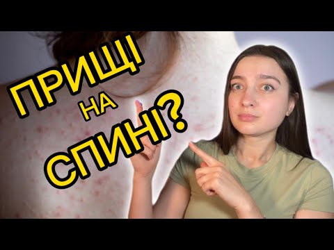 Видео: Ось чому в тебе висипи на ТІЛІ😳