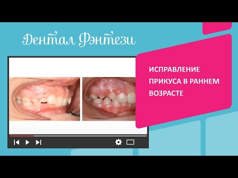 Видео: 😬 Ортодонтия у детей: исправление прикуса в раннем возрасте