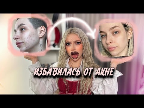 Видео: ЛЕЧЕНИЕ АКНЕ. СИСТЕМНЫЕ РЕТИНОИДЫ и передоз