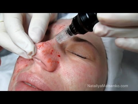 Видео: Дермапен (Dermapen) Часть 2