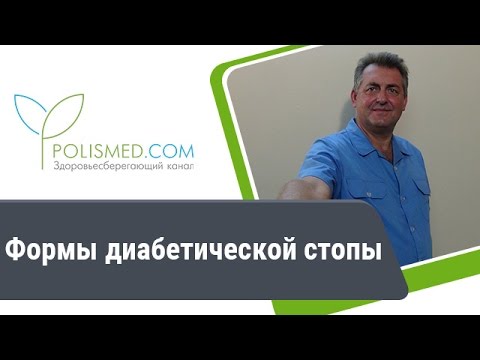 Видео: Формы диабетической стопы. Стопа Шарко. Диабетическая гангрена стопы