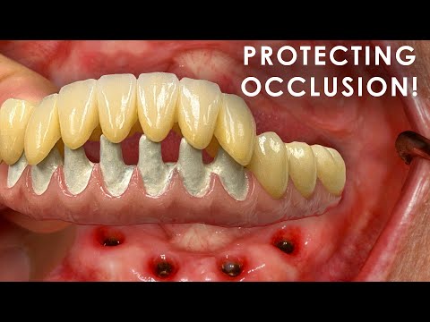 Видео: Отличные решения для защиты окклюзии при имплантации всего рта