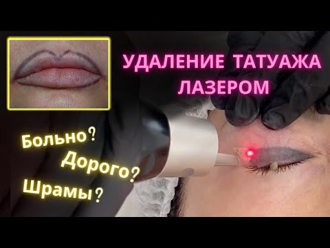 Видео: Удаление татуажа лазером. Глупые и не очень вопросы косметологу. Баски о тату и Саломея Абальян