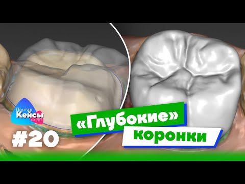 Видео: «Глубокие» коронки  | Дентал Кейсы от BG #20