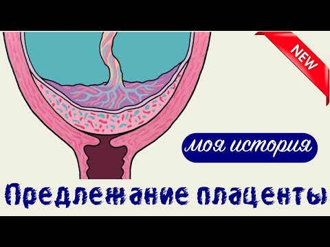 Видео: Предлежание плаценты | история моей патологии беременности