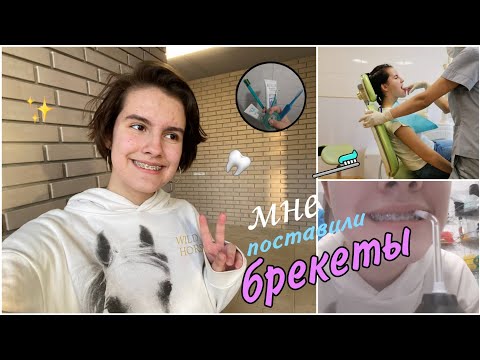 Видео: Мне поставили брекеты🦷| мои ощущения
