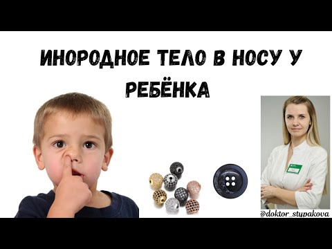 Видео: Инородное тело в полости носа.Как помочь в домашних условиях?Как понять что он у ребёнка есть в носу