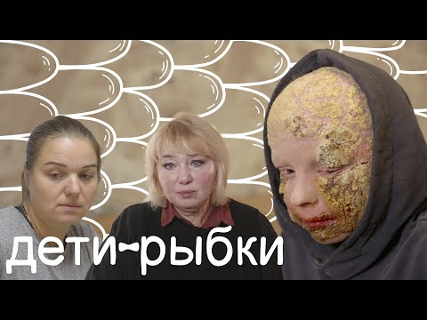 Видео: ИХТИОЗ и СИНДРОМ KID I История Кирилла Перчика