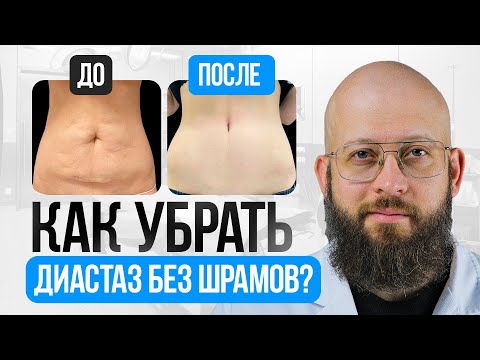 Видео: Как женщине избавиться от диастаза без шрамов?