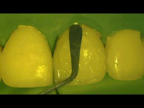 Видео: Композитная реставрация шести передних зубов. Direct composite restoration of the front teeth