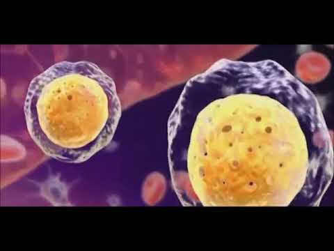 Видео: Множественная миелома