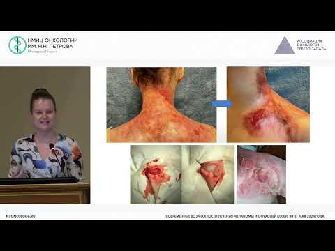 Видео: Возможности хирургического лечения немеланомных опухолей кожи