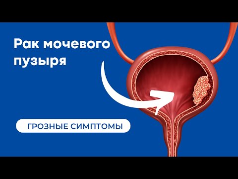 Видео: Симптомы рака мочевого пузыря | Что делать если в моче кровь