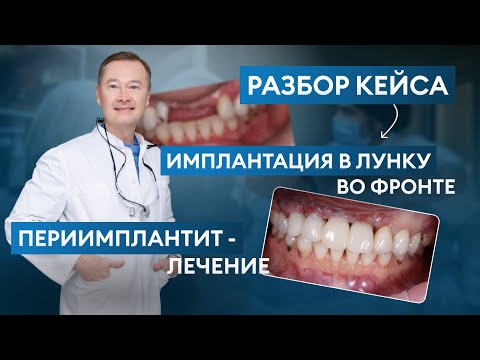 Видео: ИМПЛАНТАЦИЯ в Лунку + Лечение ПЕРИИМПЛАНТИТА / Разбор Клинического Кейса