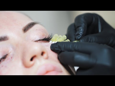 Видео: Видео установки нитей в периорбитальной области глаз и по спинке носа