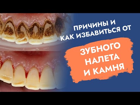 Видео: Камни на зубах. Налет на зубах. Причины. Как избавиться?